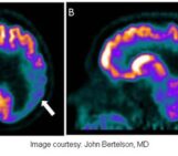 Collaboration aimed at long-term Alzheimer’s genetics, biomarkers study