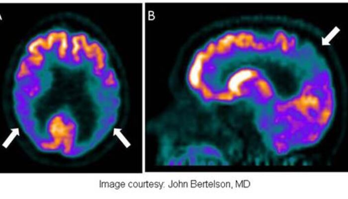 Collaboration aimed at long-term Alzheimer’s genetics, biomarkers study